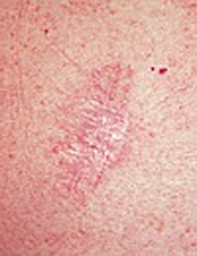 skincancer_slide0023_image036 Basal Cell Carcinoma Warning Signs