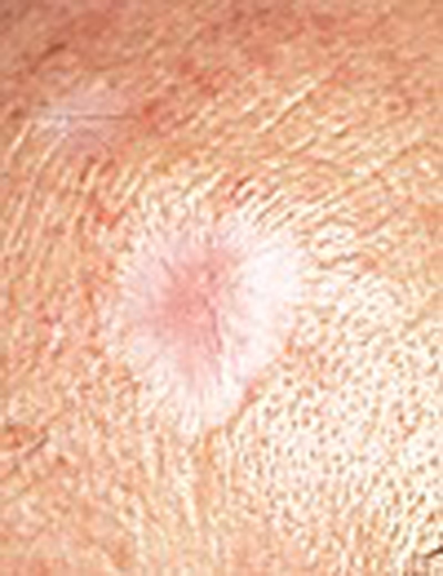 skincancer_slide0023_image038 Basal Cell Carcinoma Warning Signs