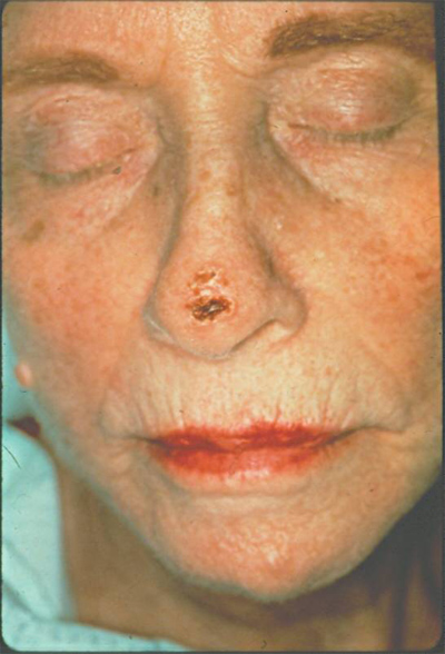 Squamous cell carcinoma (SCC)