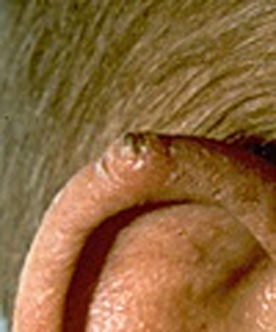 Squamous cell carcinoma (SCC)