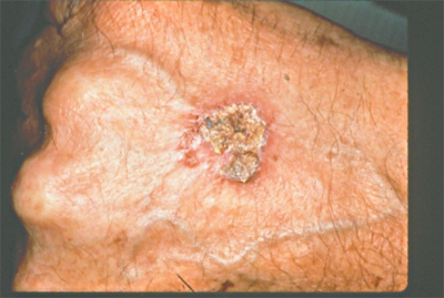 Squamous cell carcinoma (SCC)