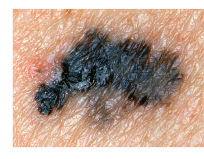 skincancer_slide0030_image057 Melanoma Border