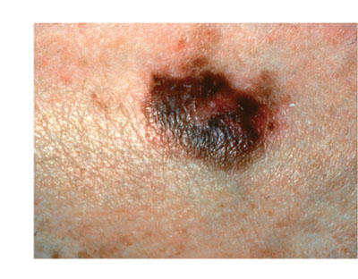 skincancer_slide0031_image061 Melanoma Color