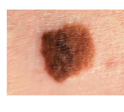 skincancer_slide0032_image065 Melanoma Diameter