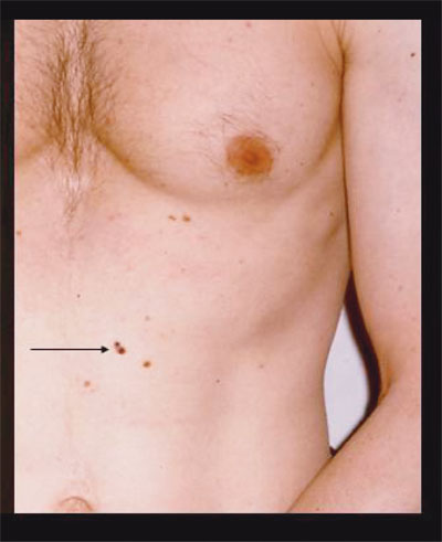 skincancer_slide0033_image069 Melanoma Evolving