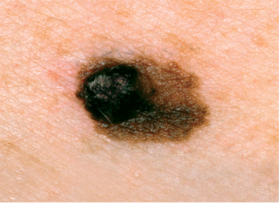 Melanoma treatment detection biopsy mohs surgery surgeon dermatologisst miami